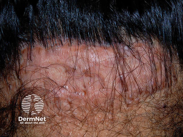 Scarring and alopecia on the neck following treatment for folliculitis keloidalis nuchae