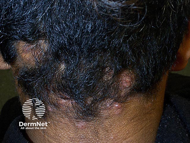 Small papules and nodules with overlying alopecia due to FKN