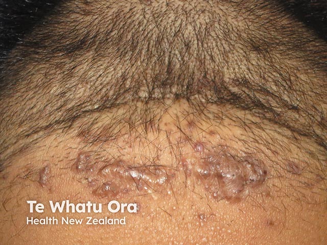 Papules, nodules and keloid like scars on the nape