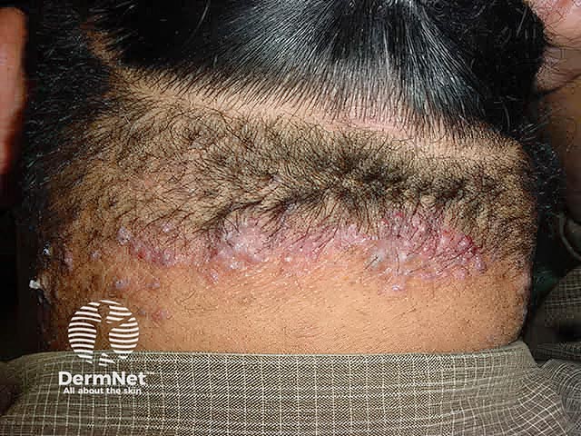 Folliculitis keloidalis nuchae on the nape of the neck