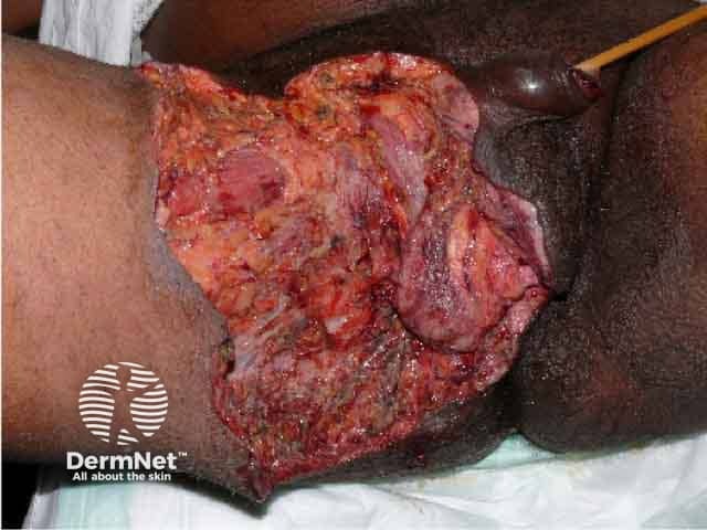 Fournier gangrene after debridement of necrotic tissue