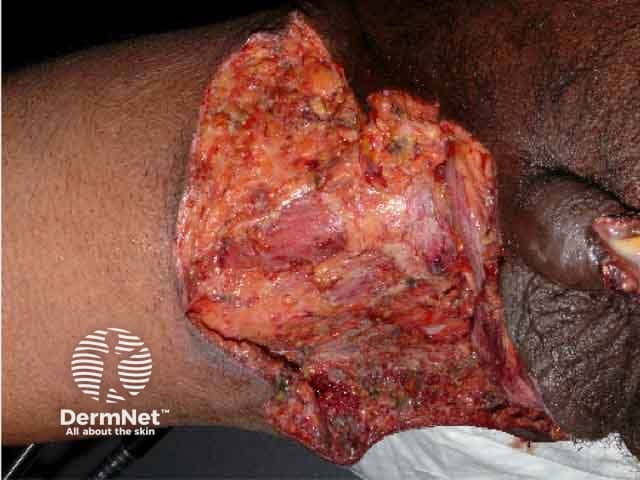 Fournier gangrene after debridement of necrotic tissue