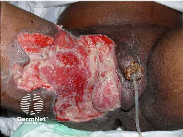 Fournier gangrene after debridement of necrotic tissue