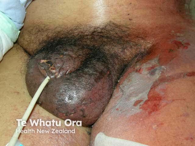 Fournier gangrene showing dusky oedema of the scrotum and penis and epidermal necrosis over the groin