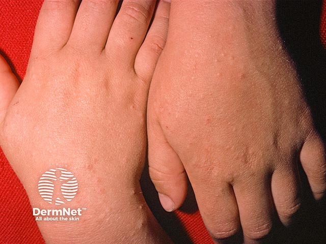 2 mm pale papules on the hands in frictional lichenoid dermatosis