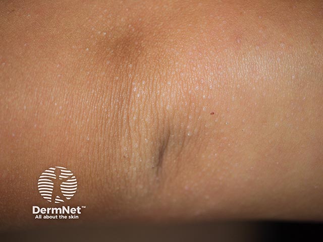 2 mm pale papules on the elbow in frictional lichenoid dermatosis