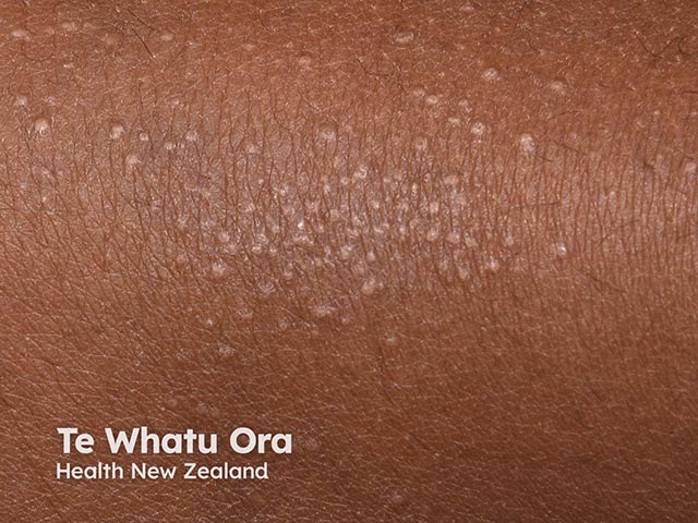 Close-up of small pale papules on the shin in frictional lichenoid dermatosis