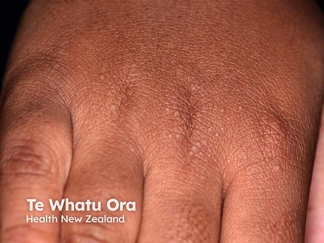 Close-up of small pale papules on the dorsal hand in frictional lichenoid dermatosis