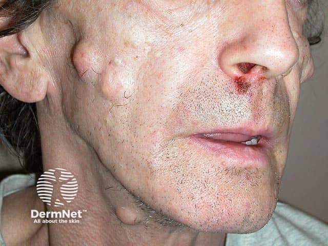 Multiple facial epidermal cysts in Gardner syndrome