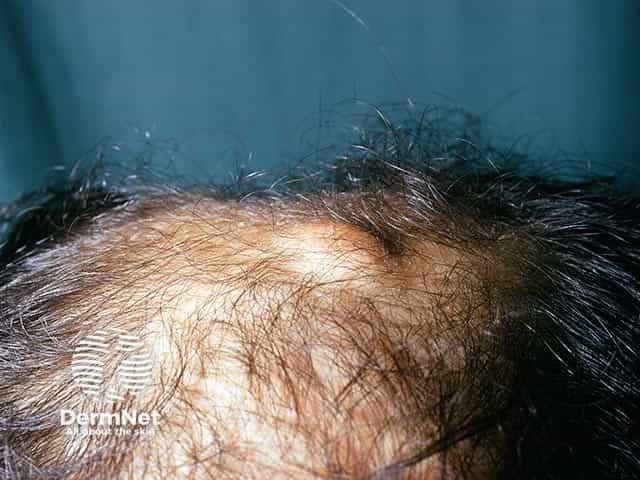 A scalp osteoma in Gardner syndrome