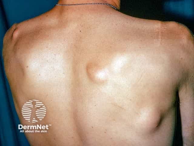 Multiple lipomas in Gardner syndrome