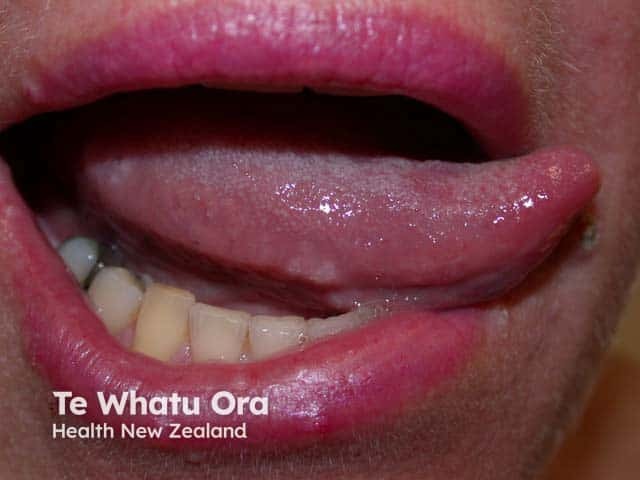 White lingual papules on the lateral border of the tongue in generalised eruptive keratoacanthomas