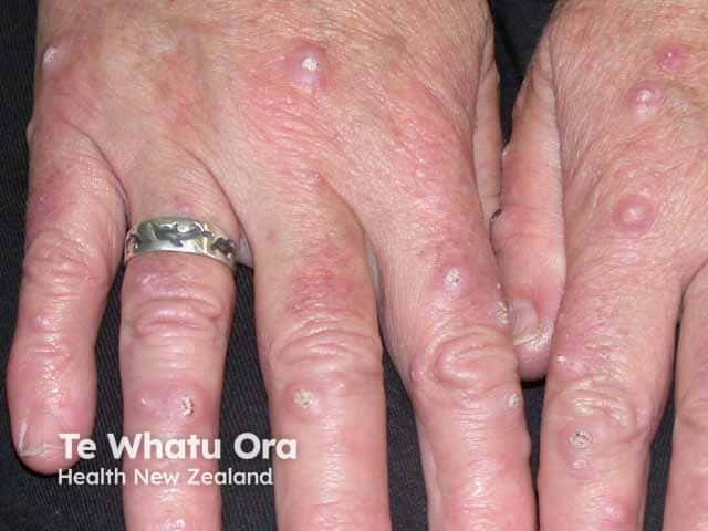 Crateriform hand papules in GEKA