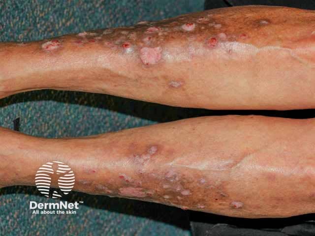 Hyperkeratotic lesions on the legs in generalised eruptive keratoacanthomas