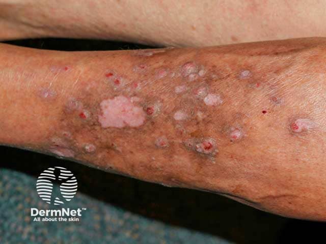 Hyperkeratotic lesions on the legs in generalised eruptive keratoacanthomas