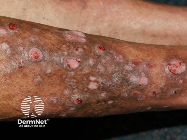 Hyperkeratotic excoriated lesions on the legs in generalised eruptive keratoacanthomas