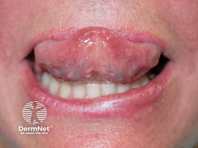 Papular lesions on the tip of the tongue in generalised eruptive keratoacanthomas