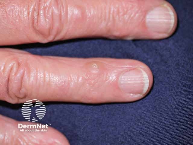 Domed papule on the finger with the typical central plug in generalised eruptive keratoacanthomas