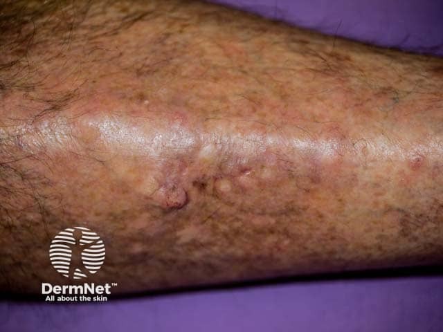 Hyperkeratotic lesions on the legs in generalised eruptive keratoacanthomas