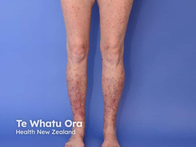 Hyperkeratotic lesions on the legs in generalised eruptive keratoacanthomas