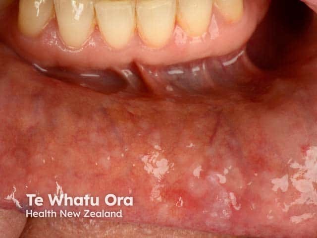 White papular leions on the labial buccal mucosa - eruptive keratoacanthomas were evident on the face and limbs