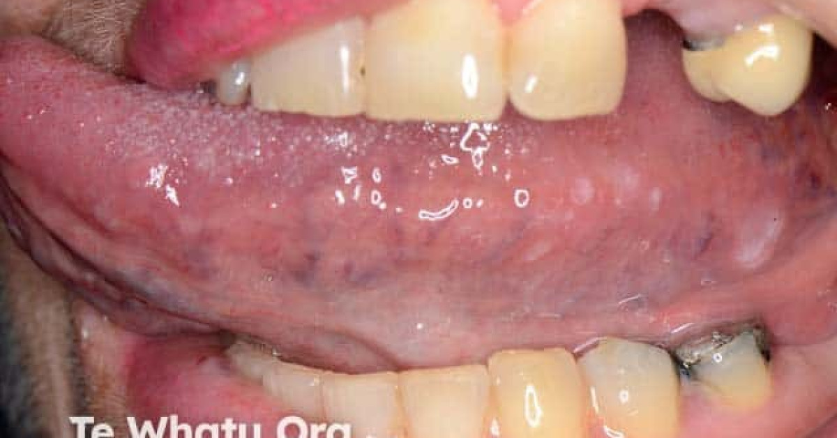 DermNet® - Generalised eruptive keratoacanthoma image