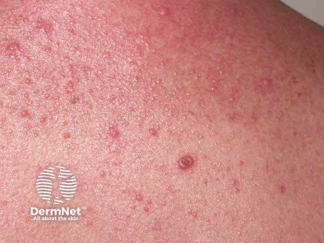 Multiple domed 3-5 mm plugged papules in generalised eruptive keratoacanthomas