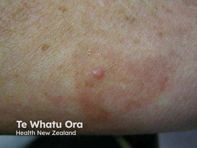 A papular lesion on the arm in a woman with generalised eruptive keratoacanthomas