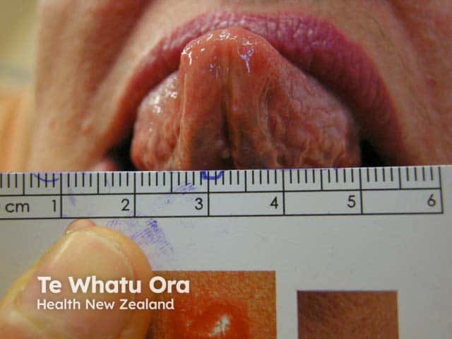 White papular lesions on the frenulum of tongue in a woman with generalised eruptive keratoacanthomas