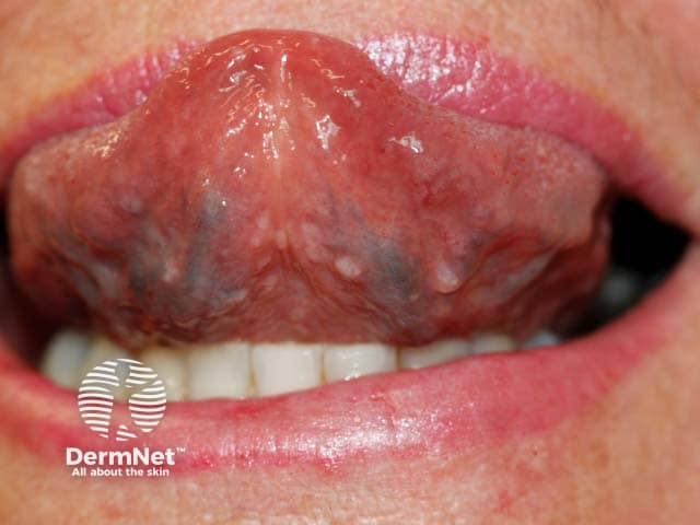 White papular lesions on the tongue in a woman with generalised eruptive keratoacanthomas