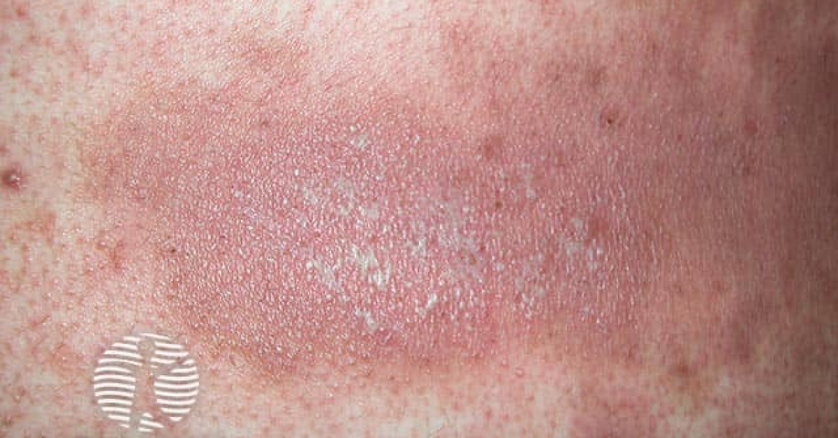 Generalised pustular psoriasis image