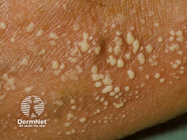Pustular psoriasis on a limb in skin of colour