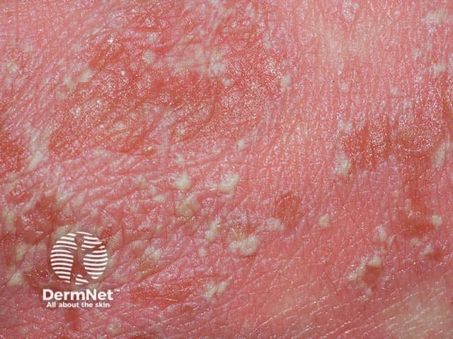 Generalised Pustular Psoriasis Images — DermNet