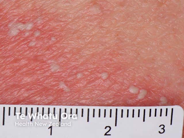 Superficial pustules on a background of diffuse erythema in generalised pustular psoriasis