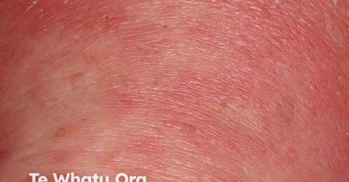 DermNet® - Generalised pustular psoriasis image