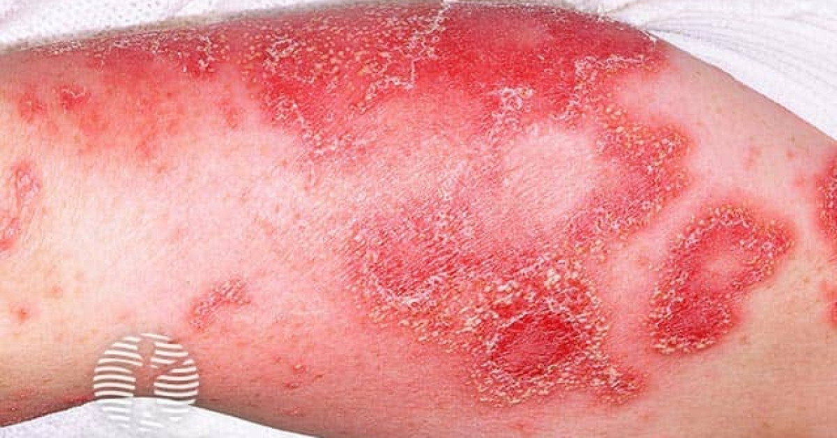 DermNet® - Generalised pustular psoriasis image