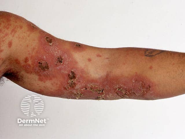 Desquamation and erythema of the arm skin after resolution of pustules in generalsied pustular psoriasis