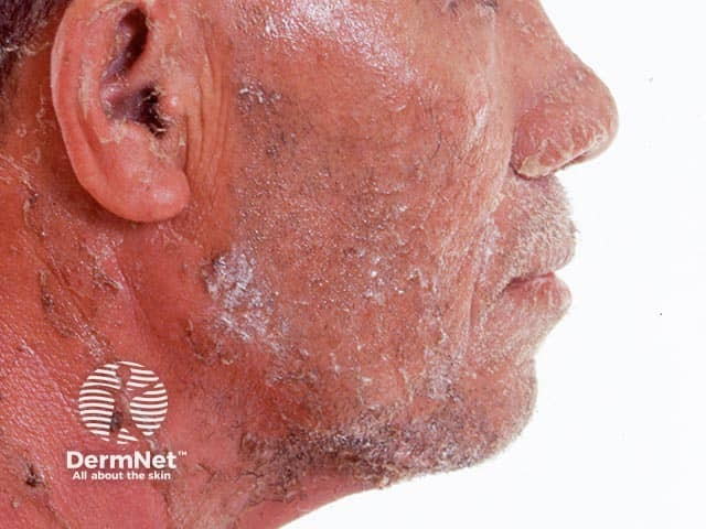 Erythema and desquamation of the facial skin after resolution of pustules in generalsied  pustular psoriasis