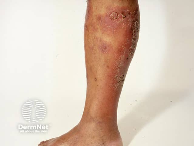 Myriads of superficial 2-3 mm pustules in generalised pustular psoriasis on the leg