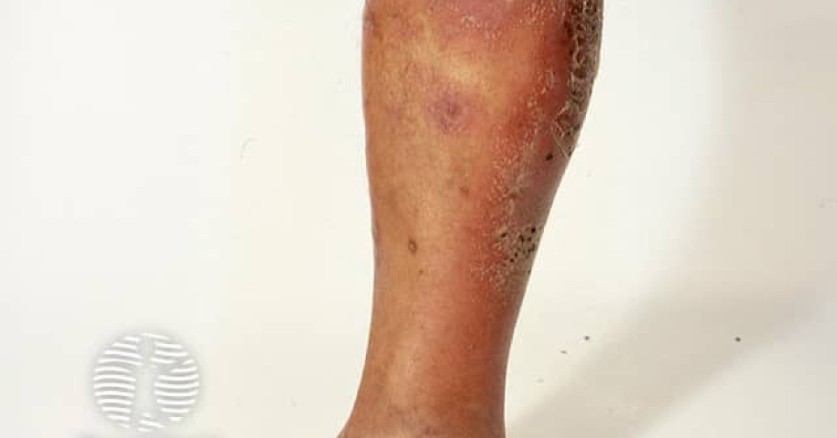 Generalised pustular psoriasis image