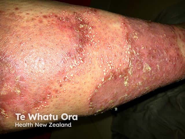 Myriads of superficial 2-3 mm pustules at the advancing edge of the lesions in generalised pustular psoriasis on the leg