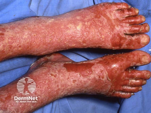 Large lakes of confluent pustules and erosions on the legs in erythrodermic generalised pustular psoriasis