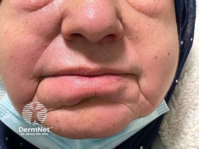 Diffuse swelling of the lower lip and facial lymphoedema due to granulomatous cheilitis - ultimately she developed intestinal Crohn disease