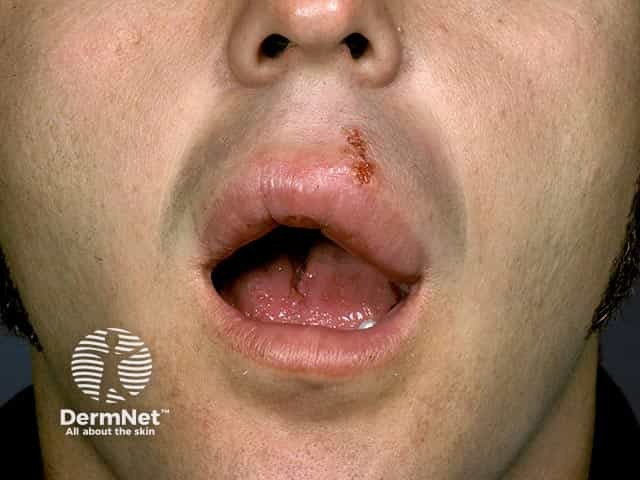 Upper lip swelling and fissuring due to granulomatous cheilitis