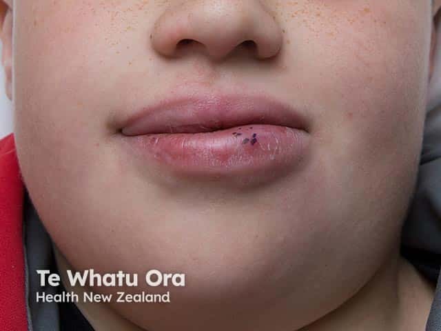 Chronic swelling of the lower lip due to granulomatous cheilitis