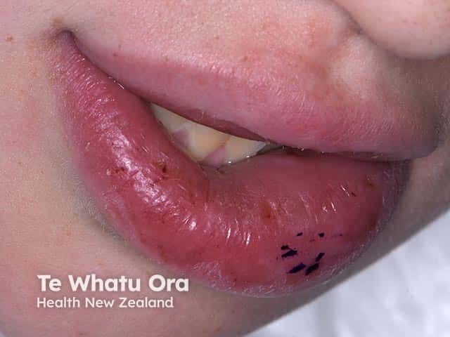 Fissuring can be seen on the lower lip affected by granulomatous cheilitis