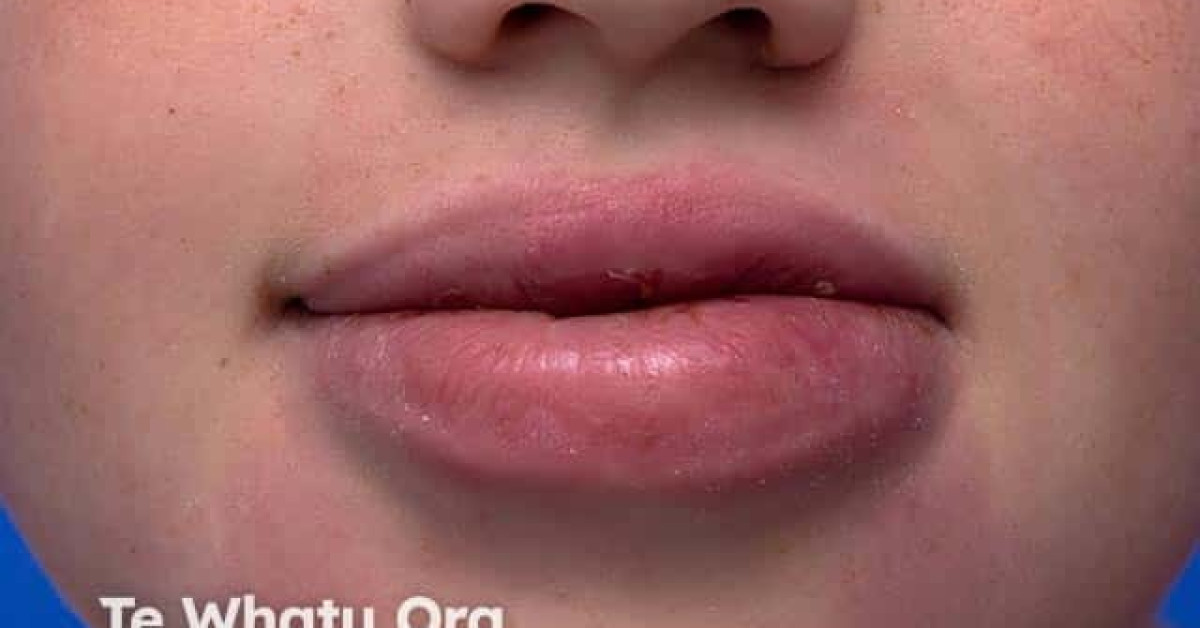 Granulomatous cheilitis image