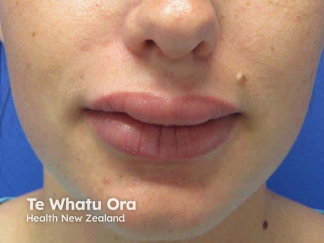 Upper and lower lip swelling with lower lip fissuring due to granulomatous cheilitis