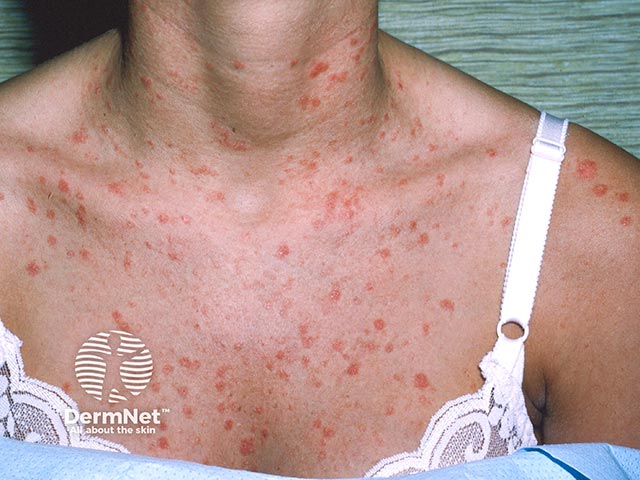 Typical scaly patches and plaques due to guttate psoriasis over the chest