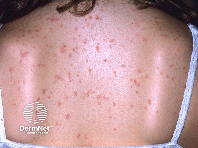 Discrete salmon-pink scaly papules over the back after a sore throat - guttate psoriasis